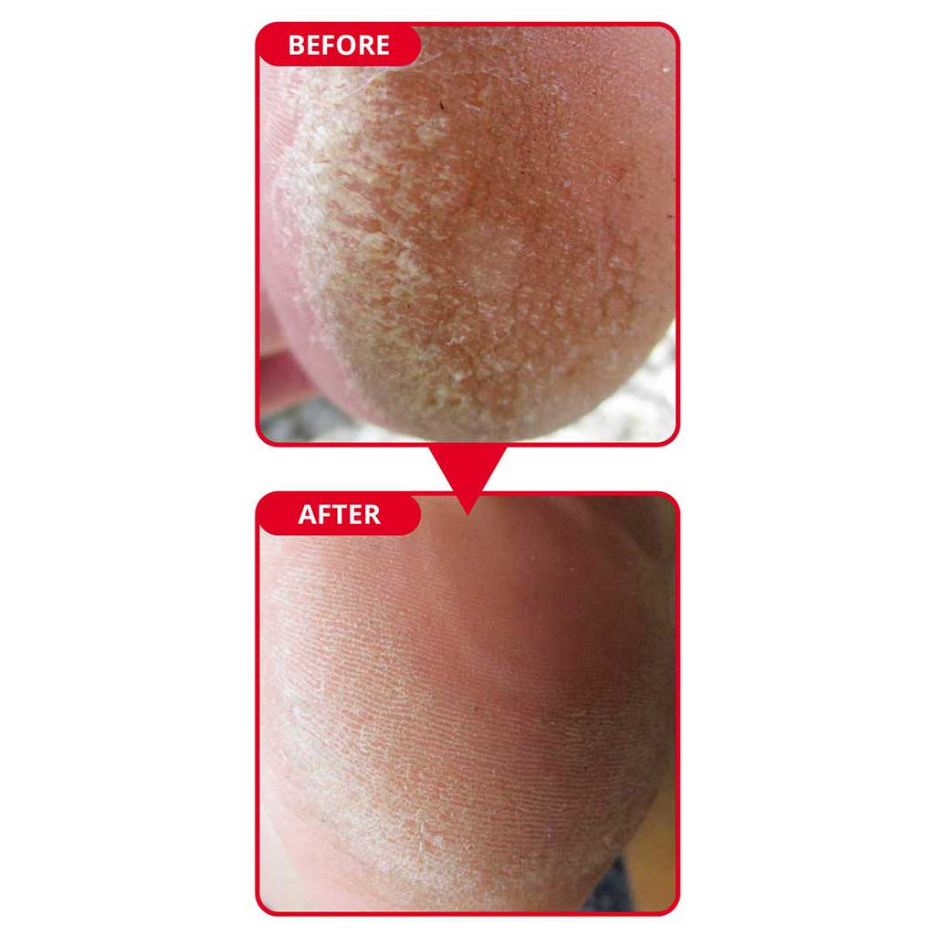 Callus Remove for Diabetic Foot - The Safest & Effective Callus Solution for Diabetic Foot!